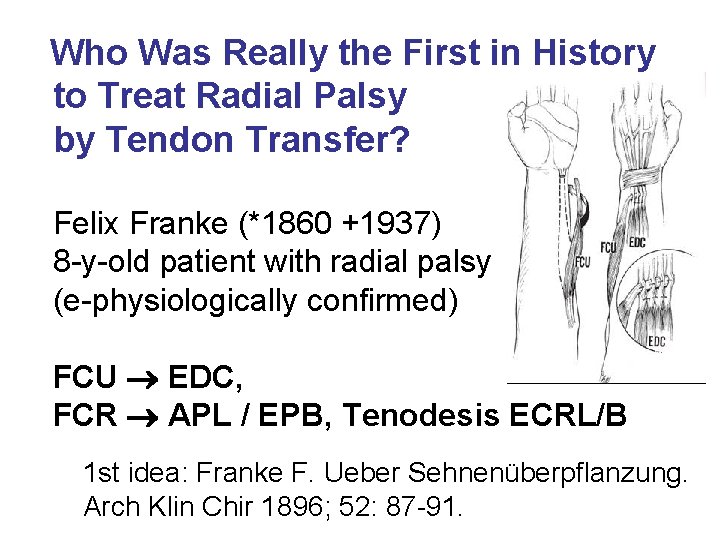 Who Was Really the First in History to Treat Radial Palsy by Tendon Transfer? Who Was Really the First in History to Treat Radial Palsy by Tendon Transfer?