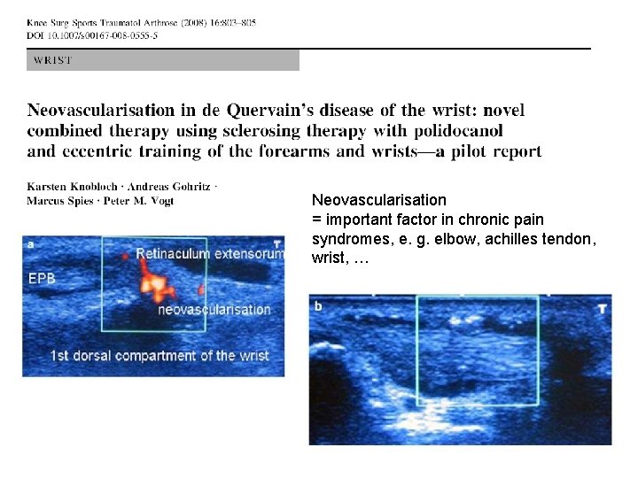 Neovascularisation = important factor in chronic pain syndromes, e. g. elbow, achilles tendon, wrist, Neovascularisation = important factor in chronic pain syndromes, e. g. elbow, achilles tendon, wrist,