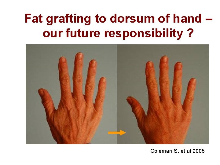 Fat grafting to dorsum of hand – our future responsibility ? Coleman S. et Fat grafting to dorsum of hand – our future responsibility ? Coleman S. et
