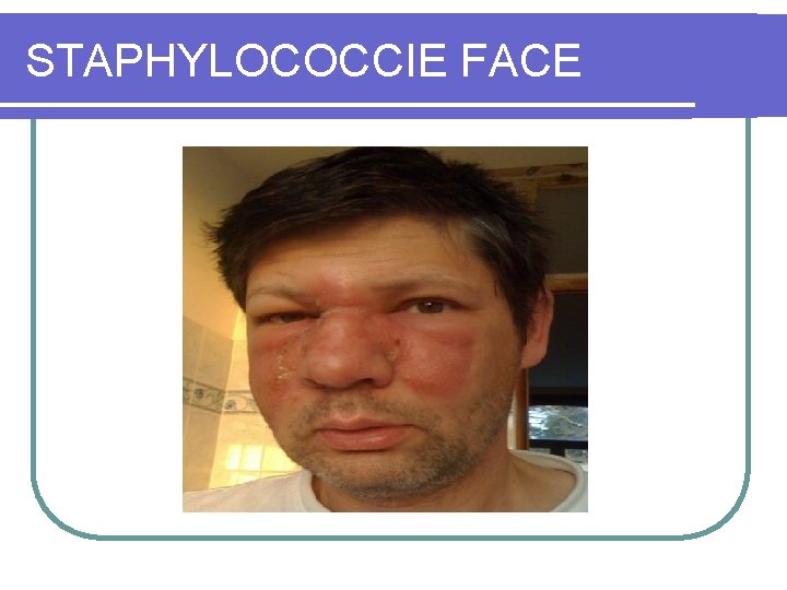 STAPHYLOCOCCIE FACE 