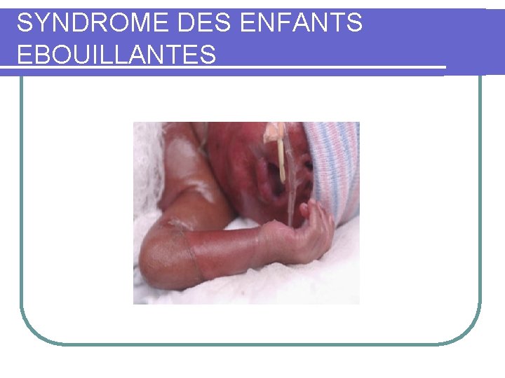 SYNDROME DES ENFANTS EBOUILLANTES 