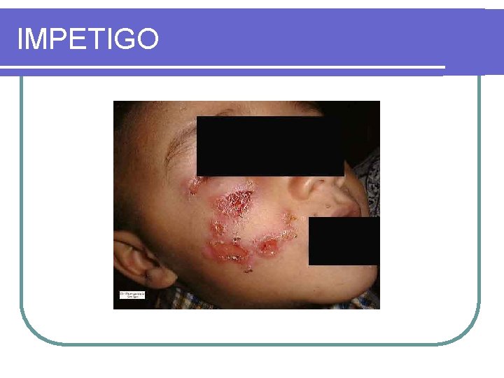 IMPETIGO 