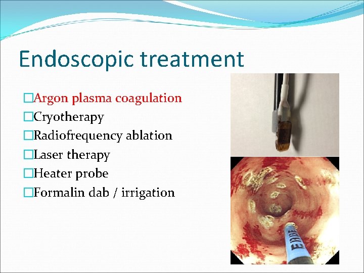 Endoscopic treatment �Argon plasma coagulation �Cryotherapy �Radiofrequency ablation �Laser therapy �Heater probe �Formalin dab Endoscopic treatment �Argon plasma coagulation �Cryotherapy �Radiofrequency ablation �Laser therapy �Heater probe �Formalin dab