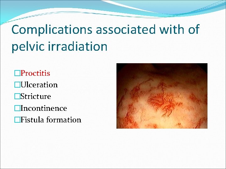 Complications associated with of pelvic irradiation �Proctitis �Ulceration �Stricture �Incontinence �Fistula formation Complications associated with of pelvic irradiation �Proctitis �Ulceration �Stricture �Incontinence �Fistula formation
