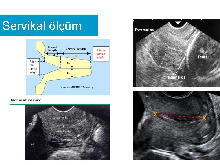 Servikal ölçüm 