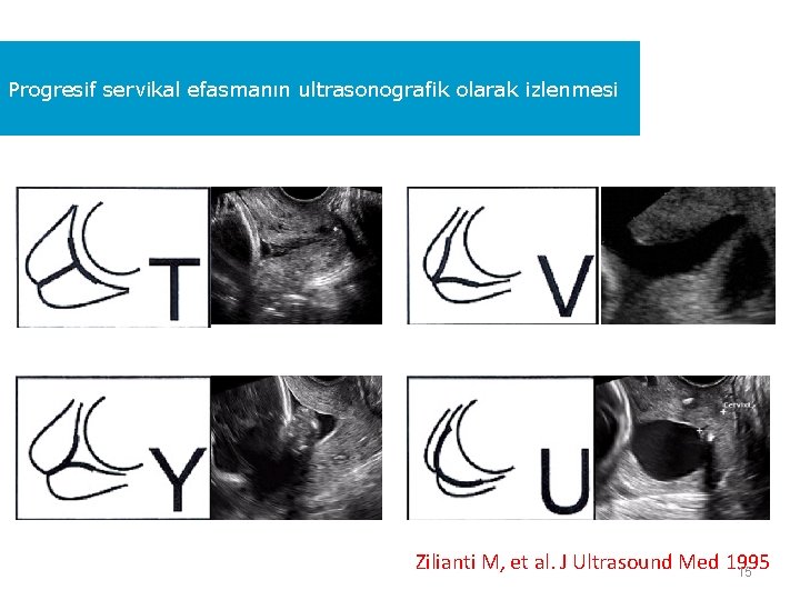 Progresif servikal efasmanın ultrasonografik olarak izlenmesi Zilianti M, et al. J Ultrasound Med 1995