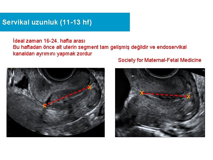 Servikal uzunluk (11 -13 hf) İdeal zaman 16 -24. hafta arası Bu haftadan önce