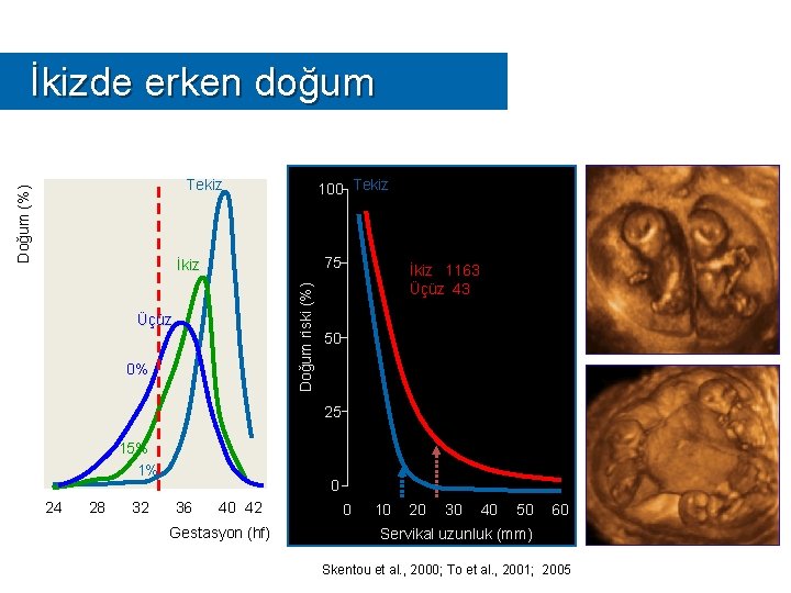 İkizde erken doğum Doğum (%) Tekiz 100 Tekiz 75 Doğum riski (%) İkiz Üçüz