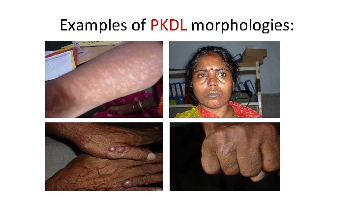 Examples of PKDL morphologies: 