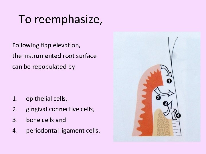 To reemphasize, Following flap elevation, the instrumented root surface can be repopulated by 1.