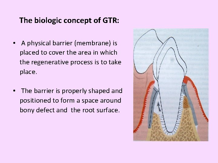 The biologic concept of GTR: • A physical barrier (membrane) is placed to cover