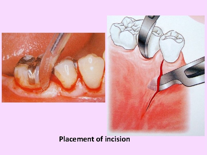 Placement of incision 