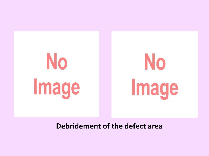Debridement of the defect area 