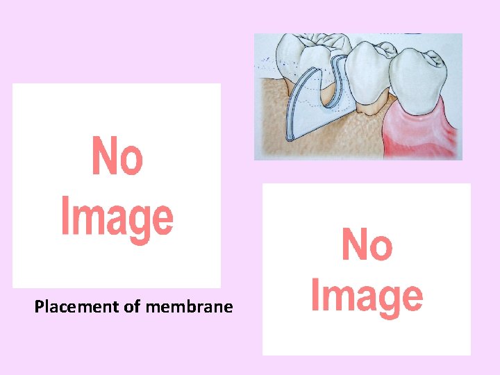 Placement of membrane 