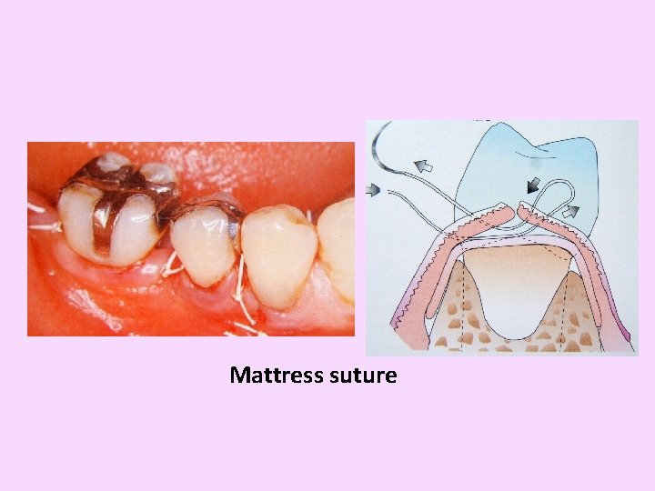 Mattress suture 