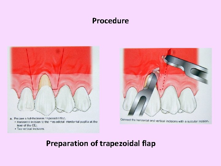 Procedure Preparation of trapezoidal flap 