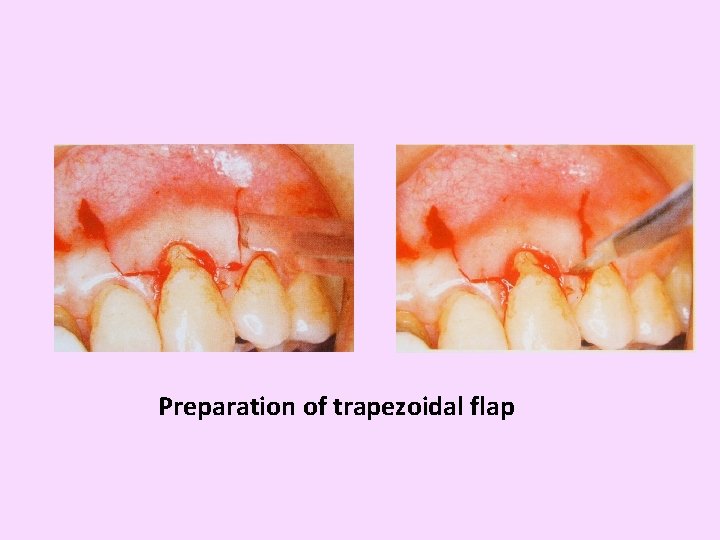 Preparation of trapezoidal flap 