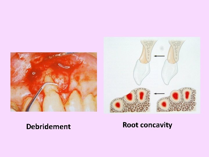 Debridement Root concavity 