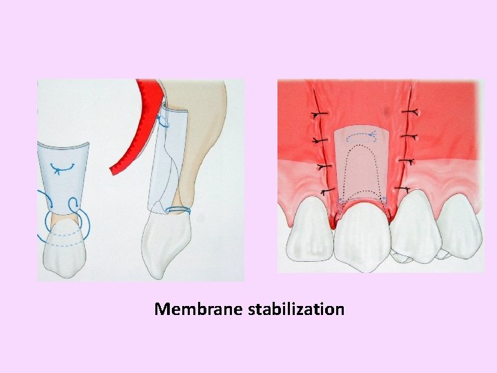 Membrane stabilization 