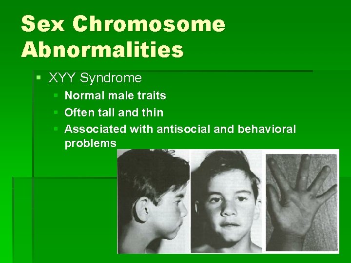 Sex Chromosome Abnormalities § XYY Syndrome § Normal male traits § Often tall and