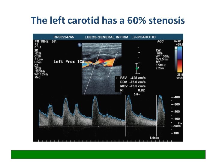 The left carotid has a 60% stenosis 