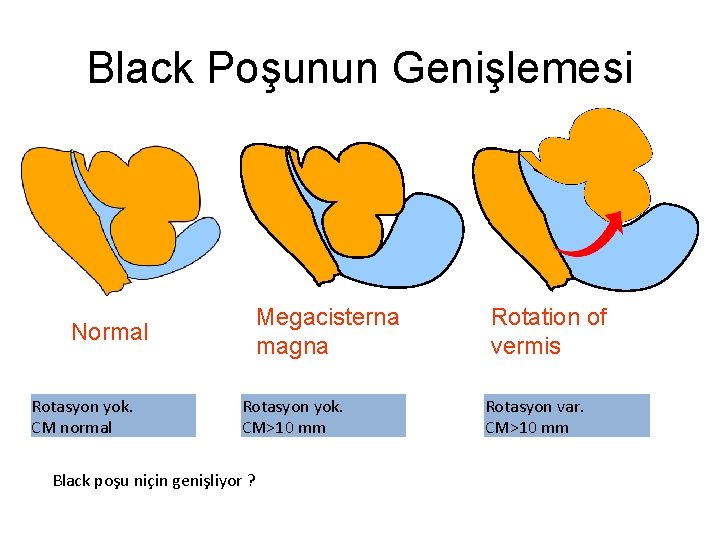 Black Poşunun Genişlemesi Megacisterna magna Normal Rotasyon yok. CM normal Rotasyon yok. CM>10 mm