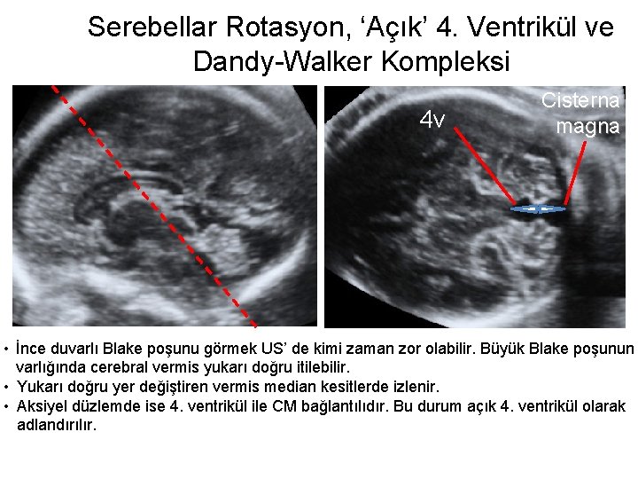 Serebellar Rotasyon, ‘Açık’ 4. Ventrikül ve Dandy-Walker Kompleksi 4 v Cisterna magna • İnce