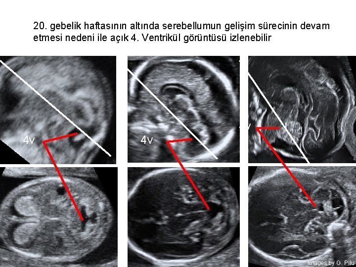 20. gebelik haftasının altında serebellumun gelişim sürecinin devam > 20 sett görüntüsü izlenebilir etmesi