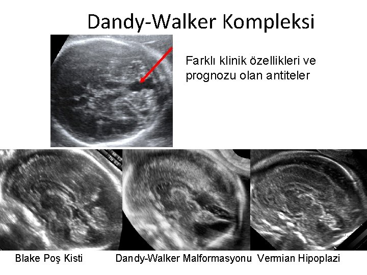 Dandy-Walker Kompleksi Farklı klinik özellikleri ve prognozu olan antiteler Blake Poş Kisti Dandy-Walker Malformasyonu