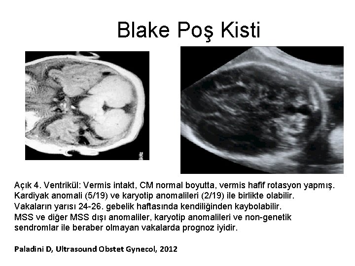 Blake Poş Kisti Açık 4. Ventrikül: Vermis intakt, CM normal boyutta, vermis hafif rotasyon