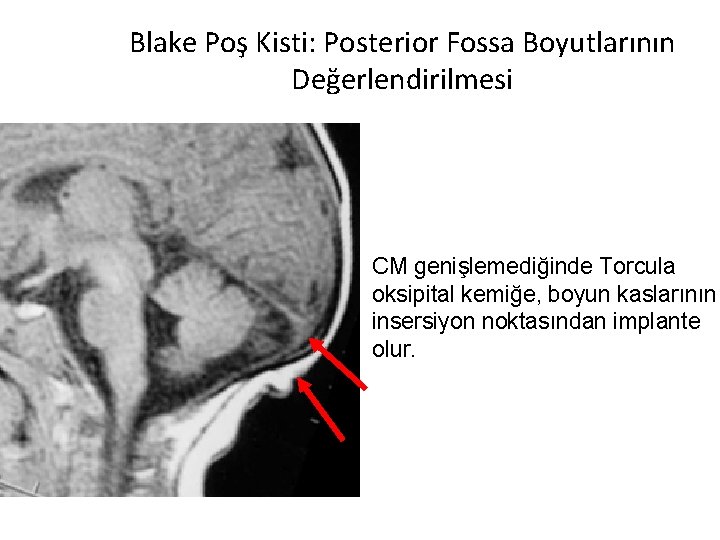 Blake Poş Kisti: Posterior Fossa Boyutlarının Değerlendirilmesi CM genişlemediğinde Torcula oksipital kemiğe, boyun kaslarının