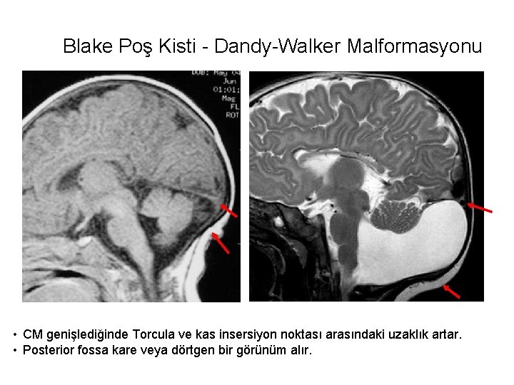 Blake Poş Kisti - Dandy-Walker Malformasyonu • CM genişlediğinde Torcula ve kas insersiyon noktası