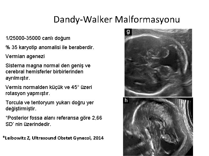 Dandy-Walker Malformasyonu 1/25000 -35000 canlı doğum % 35 karyotip anomalisi ile beraberdir. Vermian agenezi