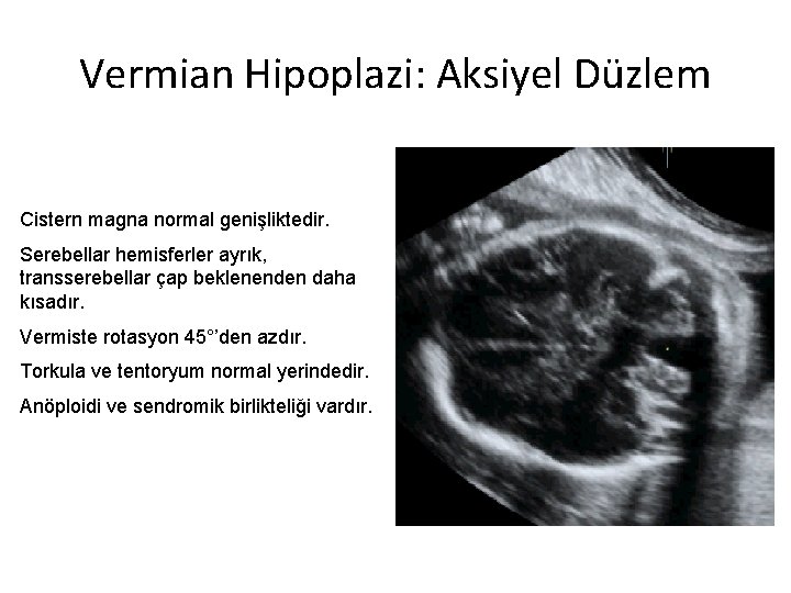 Vermian Hipoplazi: Aksiyel Düzlem Cistern magna normal genişliktedir. Serebellar hemisferler ayrık, transserebellar çap beklenenden