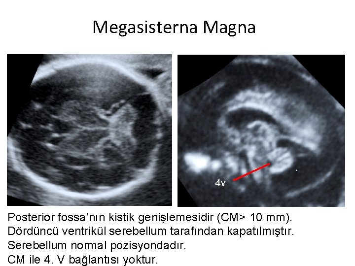 Megasisterna Magna 4 v Posterior fossa’nın kistik genişlemesidir (CM> 10 mm). Dördüncü ventrikül serebellum