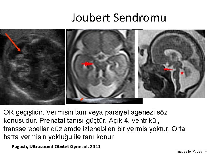 Joubert Sendromu OR geçişlidir. Vermisin tam veya parsiyel agenezi söz konusudur. Prenatal tanısı güçtür.