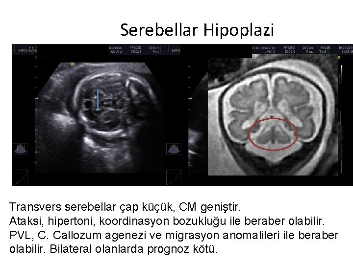 Serebellar Hipoplazi Transvers serebellar çap küçük, CM geniştir. Ataksi, hipertoni, koordinasyon bozukluğu ile beraber