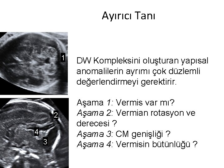 Ayırıcı Tanı 1 2 4 3 DW Kompleksini oluşturan yapısal anomalilerin ayrımı çok düzlemli