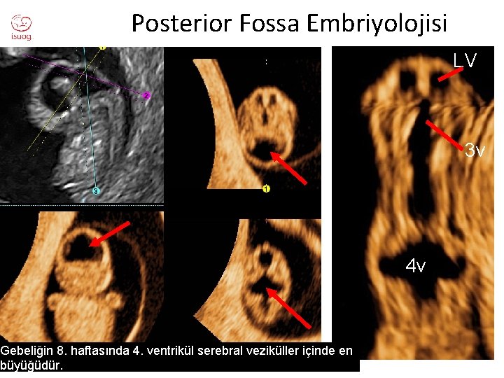 Posterior Fossa Embriyolojisi Gebeliğin 8. haftasında 4. ventrikül serebral veziküller içinde en büyüğüdür. LV