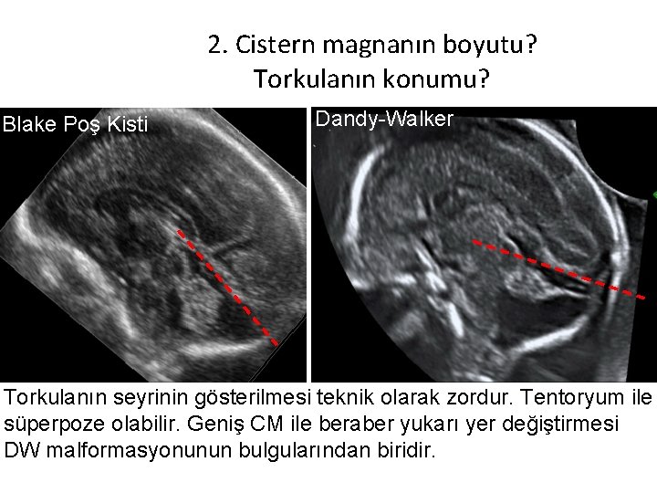2. Cistern magnanın boyutu? Torkulanın konumu? Blake Poş Kisti Dandy-Walker Torkulanın seyrinin gösterilmesi teknik