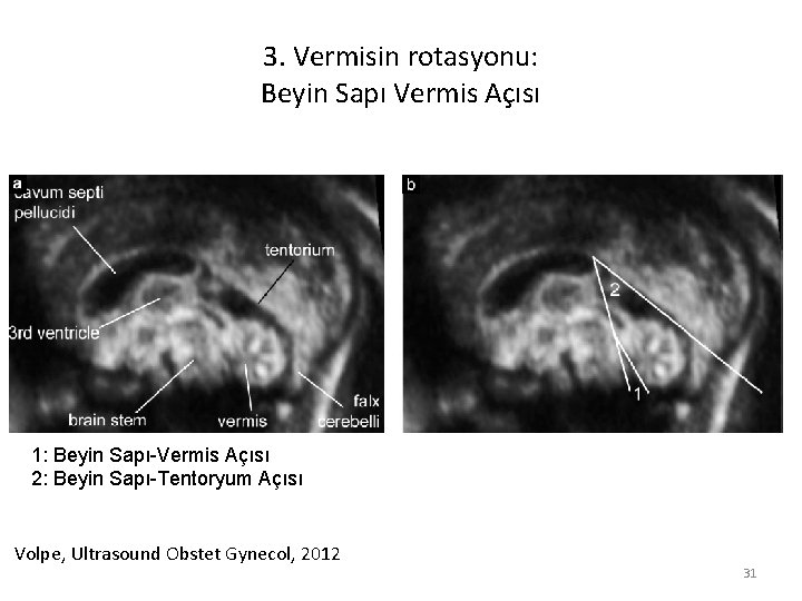 3. Vermisin rotasyonu: Beyin Sapı Vermis Açısı 1: Beyin Sapı-Vermis Açısı 2: Beyin Sapı-Tentoryum