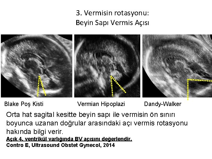 3. Vermisin rotasyonu: Beyin Sapı Vermis Açısı Blake Poş Kisti Vermian Hipoplazi Dandy-Walker Orta