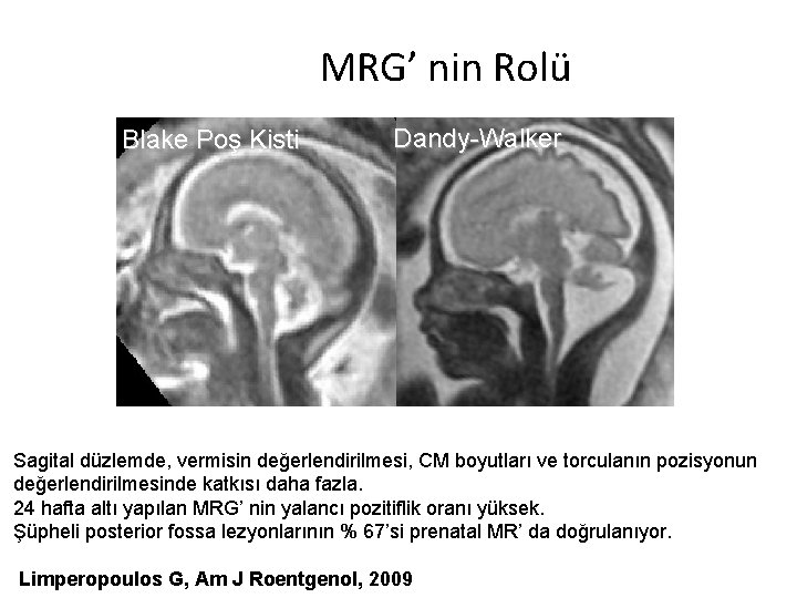 MRG’ nin Rolü Blake Poş Kisti Dandy-Walker Sagital düzlemde, vermisin değerlendirilmesi, CM boyutları ve