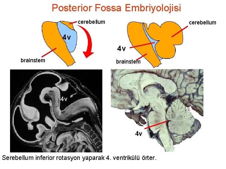 Posterior Fossa Embriyolojisi cerebellum 4 v 4 v brainstem 4 v 4 v Serebellum