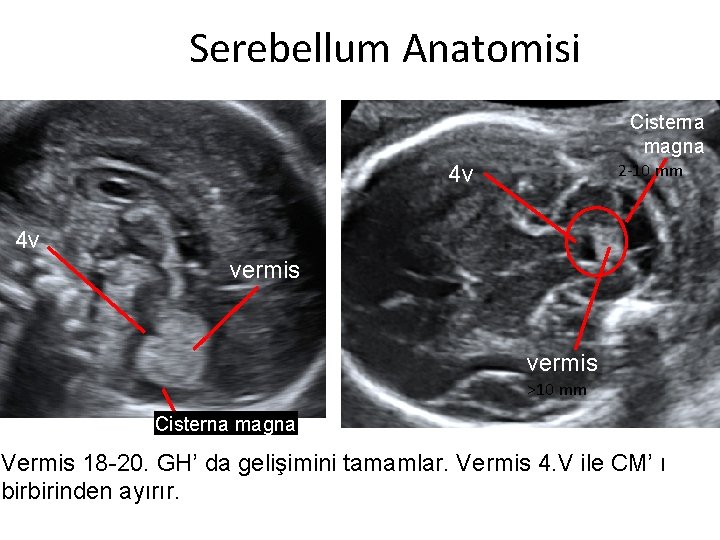 Serebellum Anatomisi Cisterna magna 2 -10 mm 4 v 4 v vermis >10 mm
