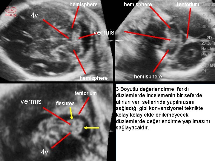 hemisphere tentorium 4 v vermis hemisphere tentorium vermis 4 v fissures hemisphere 3 Boyutlu