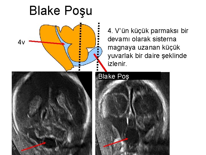 cervelletto Blake Poşu 4 v 4. V’ün küçük parmaksı bir devamı olarak sisterna magnaya