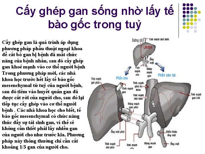 Cấy ghép gan sống nhờ lấy tế bào gốc trong tuỷ Cấy ghép gan