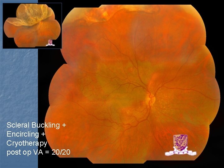 Scleral Buckling + Encircling + Cryotherapy post op VA = 20/20 