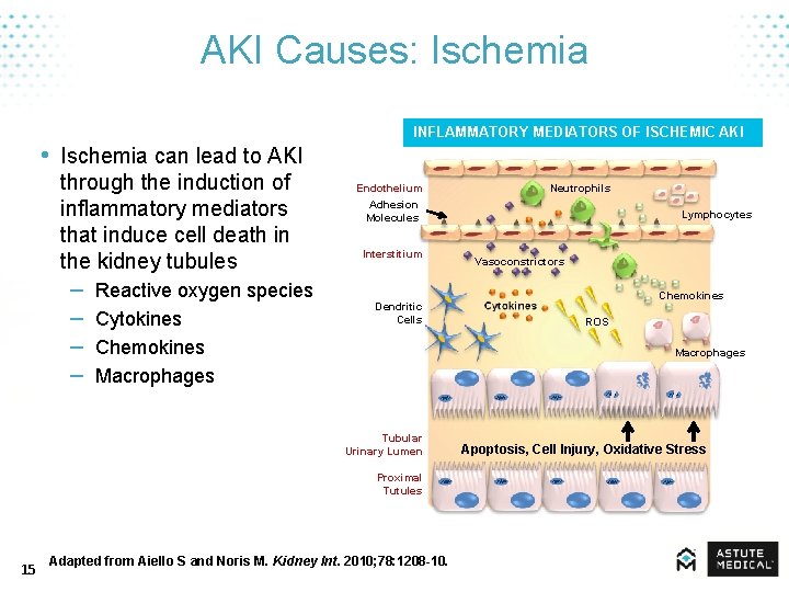 AKI Causes: Ischemia • Ischemia can lead to AKI through the induction of inflammatory